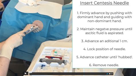 Large Volume Paracentesis | Procedure | TeachIM