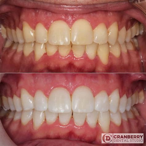 Kor Whitening - Cranberry Dental Studio