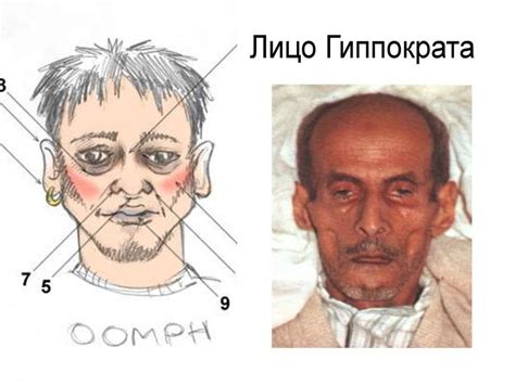 Синдром «Острого живота» - презентация онлайн