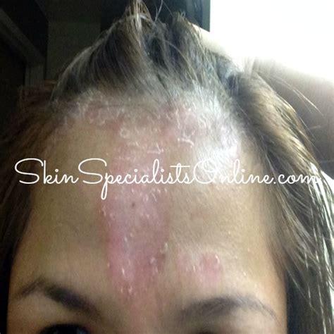 Dry Scalp Causes and Treatment - Skin Specialists Online