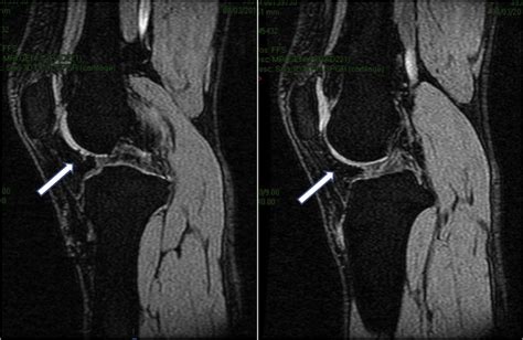 Mri Fse Cor T2 Weighted Signal In Different Slice Left Image Showing