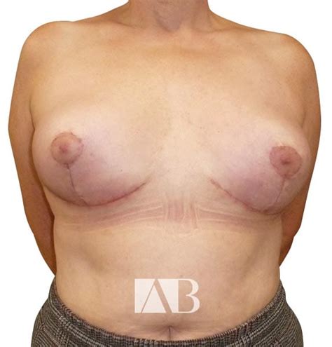 Breast Uplift Mastopexy In Chester Anca Breahna