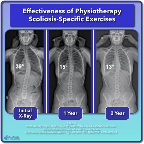 Scoliosis Treatment for Children and Teens - Scoliosis Care Centers