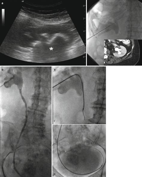 Nephrostomy Tube Ultrasound