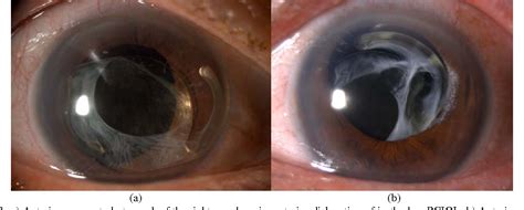 Figure From Dislocated Posterior Chamber Intraocular Lens Pciol In