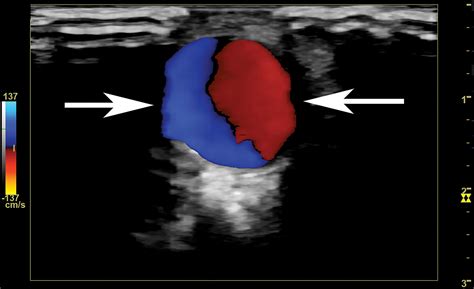 Superficial Temporal Artery Arteriovenous Fistula And Pseudoaneurysm