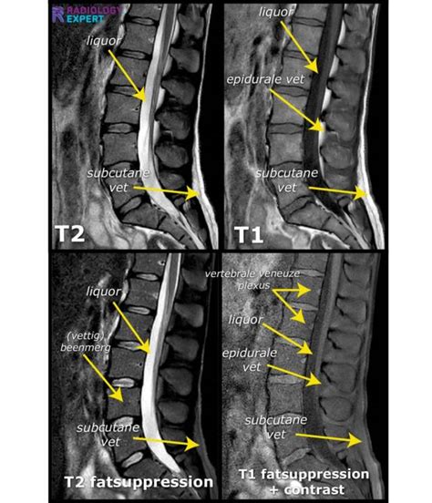 Mri Lumbar Spine