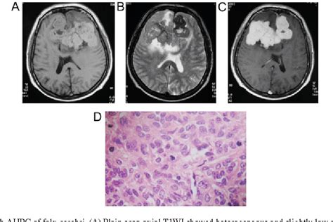 Figure 1 From MRI Features Of Intracranial Anaplastic