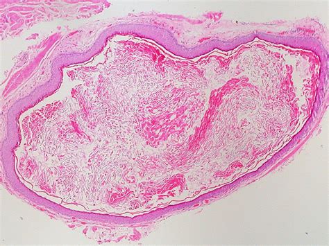 Sebaceous Cyst Drainage Smell - Best Drain Photos Primagem.Org