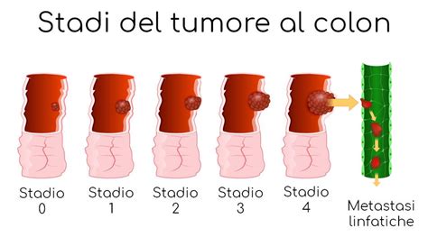 Tumore Al Colon Retto Sintomi Sopravvivenza E Cause Valori Normali