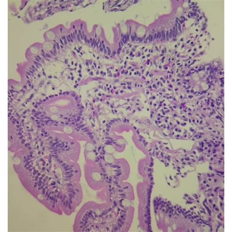 Photomicrography Of A Duodenal Mucosal Biopsy Specimen 40x Depicts