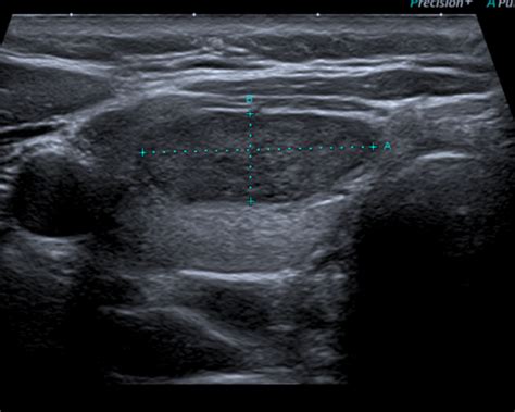 Classification Eu Tirads Toulouse Thyroide