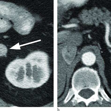 Axial Contrast Enhanced Ct Image Shows A 2 Cm Tumor Arrow In The