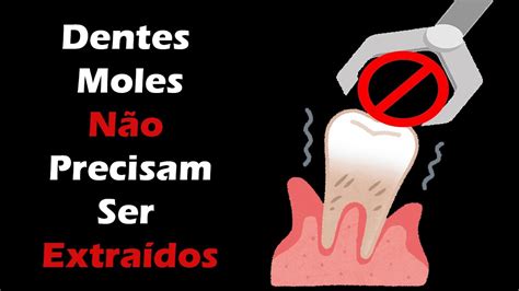 Como Fixar Dentes Moles sem Implante Dentário Periodontite Tratamento