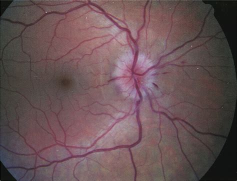 Optic Neuritis Pmc