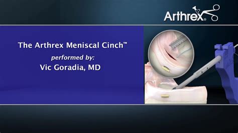 Arthrex Meniscal Cinch™ All Inside Repair