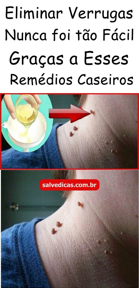 Use Pasta De Dente Para Remover Verrugas Passo A Passo Como