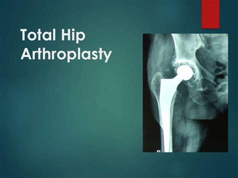 total hip arthroplasty