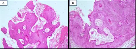 Photomicrographs Aandb Show Keratinised Stratified Squamous Epithelium