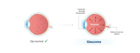 Tensi N Ocular Cu Ndo Es Alta Y Cu L Es La Normal Blog De Cl Nica