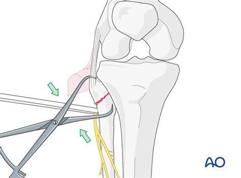 Fibula Head