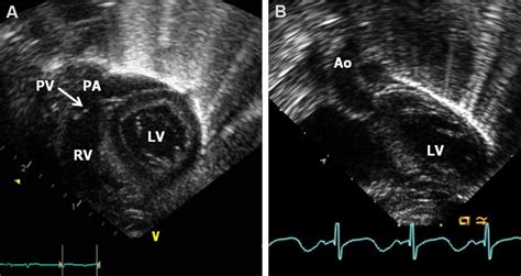 Echo frames from subcostal long-axis views of the ventricles ...