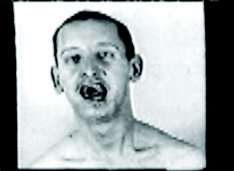 Encephalitis Lethargica Mysterious And Horrifying