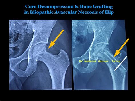 Avascular Necrosis Avn Treatment And Management Dr Ashwini Gaurav