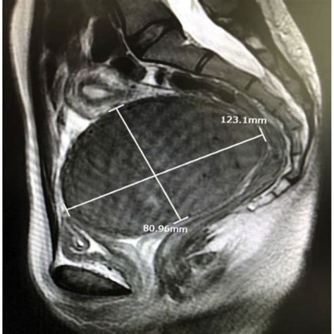 Pelvic Magnetic Resonance Imaging In Sagittal T Weighted Sequence A