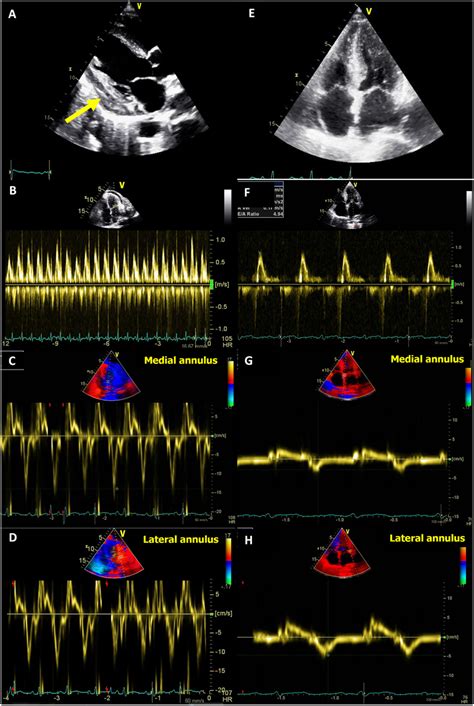 Salient Echocardiographic Differences Between Constrictive Pericarditis Download Scientific