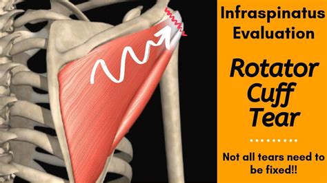 Infraspinatus Tear Evaluation Special Tests And Manual Muscle Testing