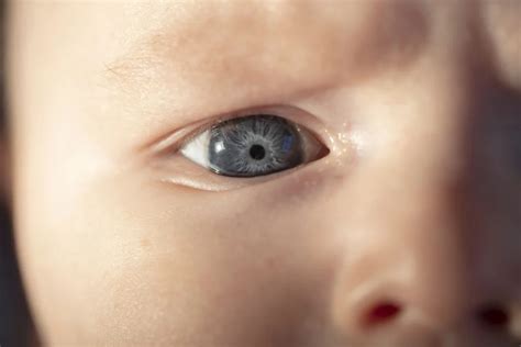 Cataracts In Children Causes Symptoms And Treatment