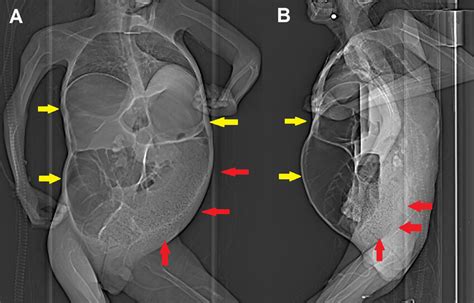 Scout Images Anteroposterior A And Lateral View B Obtained