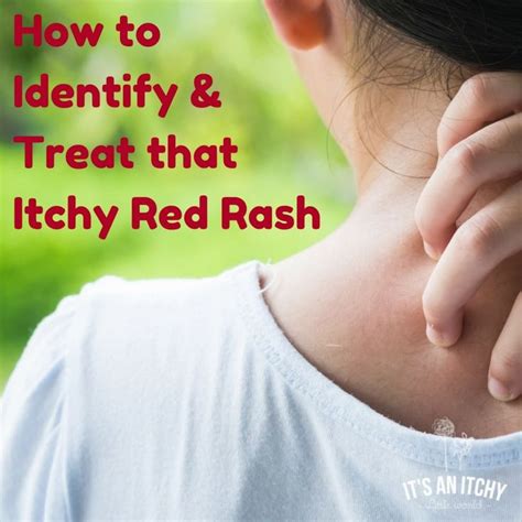 How to Identify & Treat that Itchy Red Rash | Red rash, Skin rashes ...