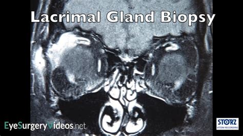 Lacrimal gland biopsy - Oculoplastic | EyeSurgeryVideos.net