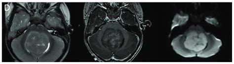 Imaging Appearances Of Molecular Subtypes Of Medulloblastoma Each Row