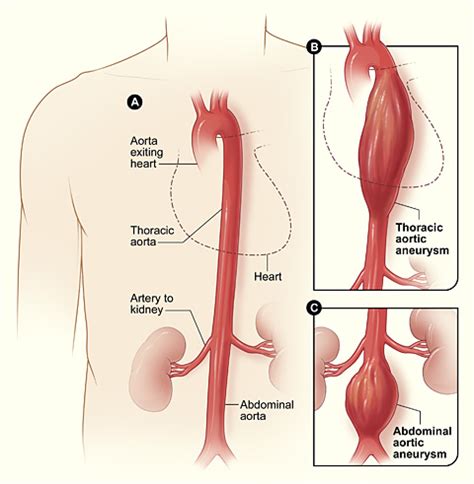 Thoracic Aortic Aneurysms | Concise Medical Knowledge