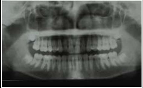 Panoramic Radiography Images Flashcards | Quizlet