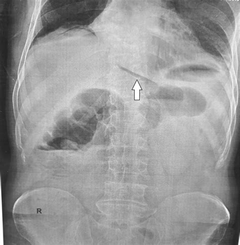 Abdominal Supine X Ray Showing Pneumoperitoneum Air Under Diaphragm Download Scientific