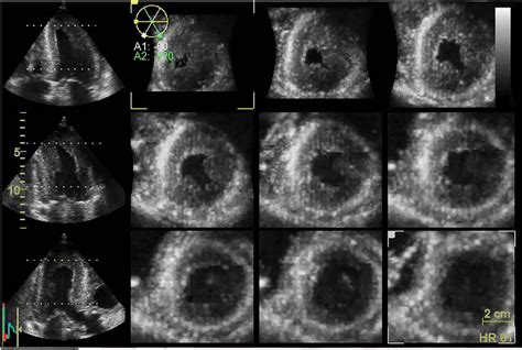 Three Dimensional Echocardiography From A Patient With Friedreichs