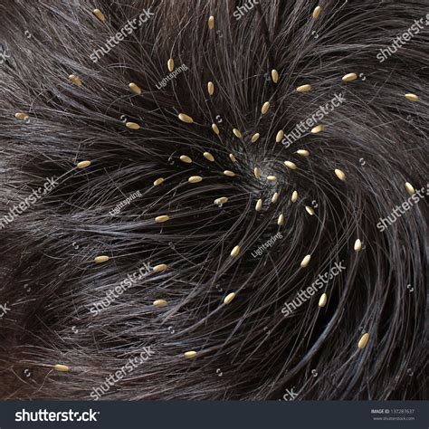 Head Lice Medical Concept Close Human Stock Illustration 137287637