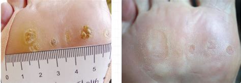 Swift Wart Therapy Rightstep Podiatry