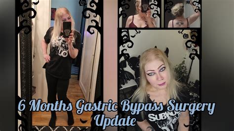 Months Postop Gastric Bypass Surgery Update Trigger Warning Youtube