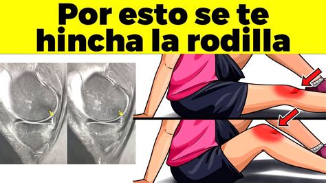 12 Razones Por Las Que Se Te Hincha La Rodilla YouTube