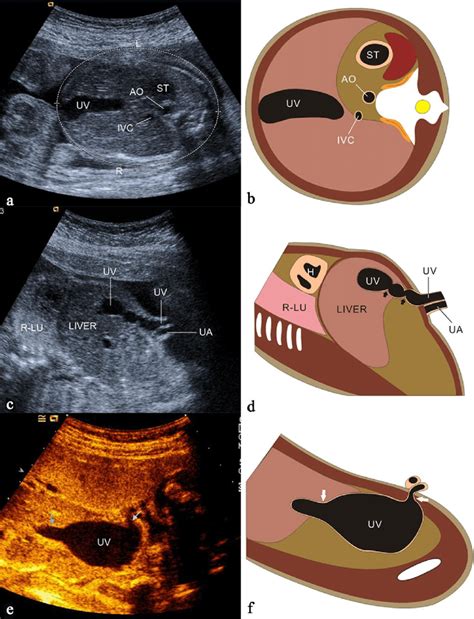 Grayscale Ultrasound Image And Scheme Of The Fetus Showing Different