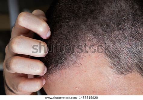 Seborrheic Dermatitis Chronic Inflammation On Skin Stock Photo Edit