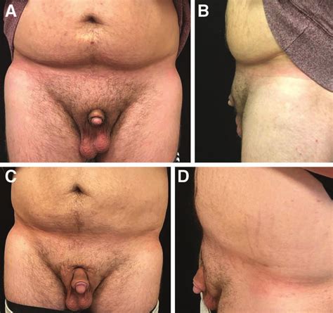 Enlargement Of A Micropenis Frontal And Lateral Views Preoperative