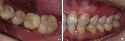 Uprighting A Mesially Tilted Mandibular Left Second Molar With Anchorage From A Dental Implant