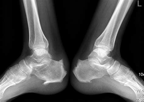 Treatment Of Calcified Insertional Achilles Tendinopathy By The Posterior Midline Approach The