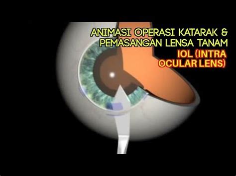 Operasi Bedah Katarak Dalam Animasi Dan Pemasangan IOL Intra Ocular